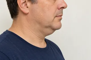 Endolazer ile Gıdı Şekillendirme